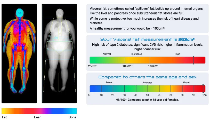 Understanding Visceral Fat